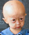 Progeria.png